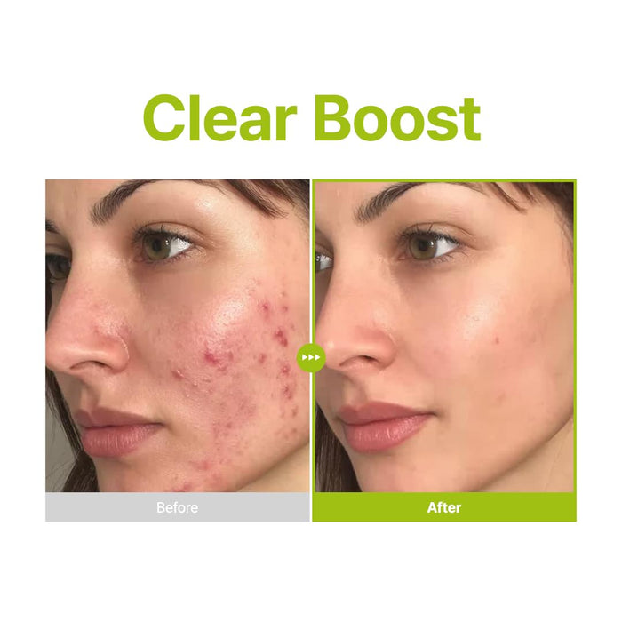 Purito Azelaic Acid 10 Kojic Tea Tree Serum (30ml)
